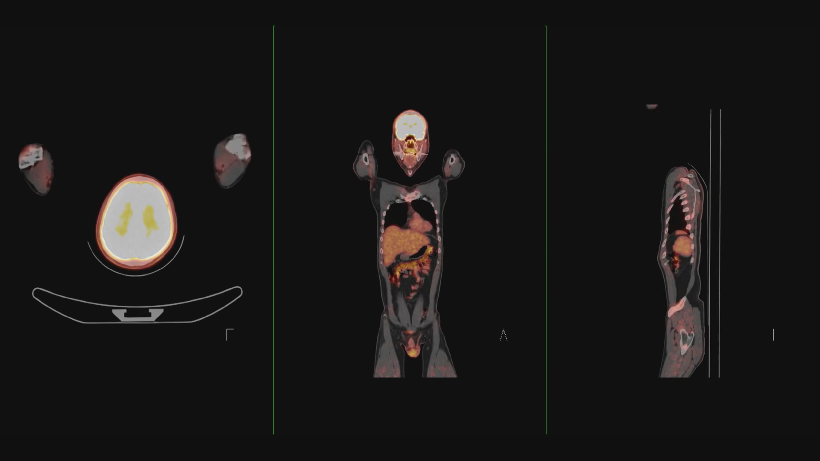 ET CT Scan fusion image of human body for detecting cancer recurrence after surgery